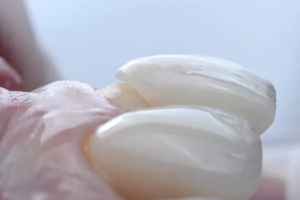Fațete dentare ceramice premium la Smile Design București