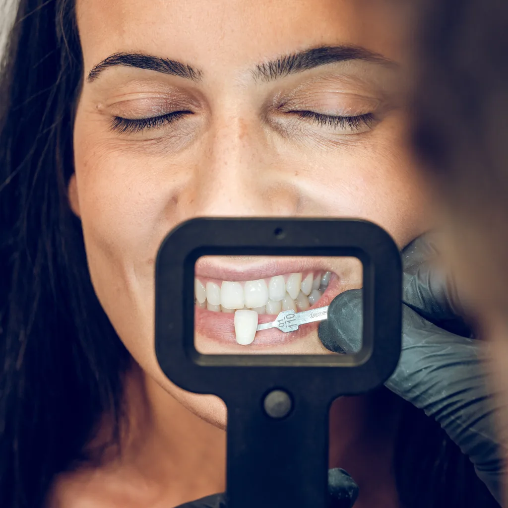 Alegerea nuanței fațetelor dentare premium la Smile Design București