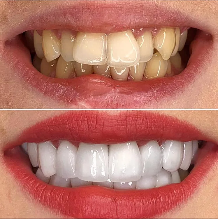 Zâmbet de Hollywood creat cu fațete dentare premium la Smile Design București