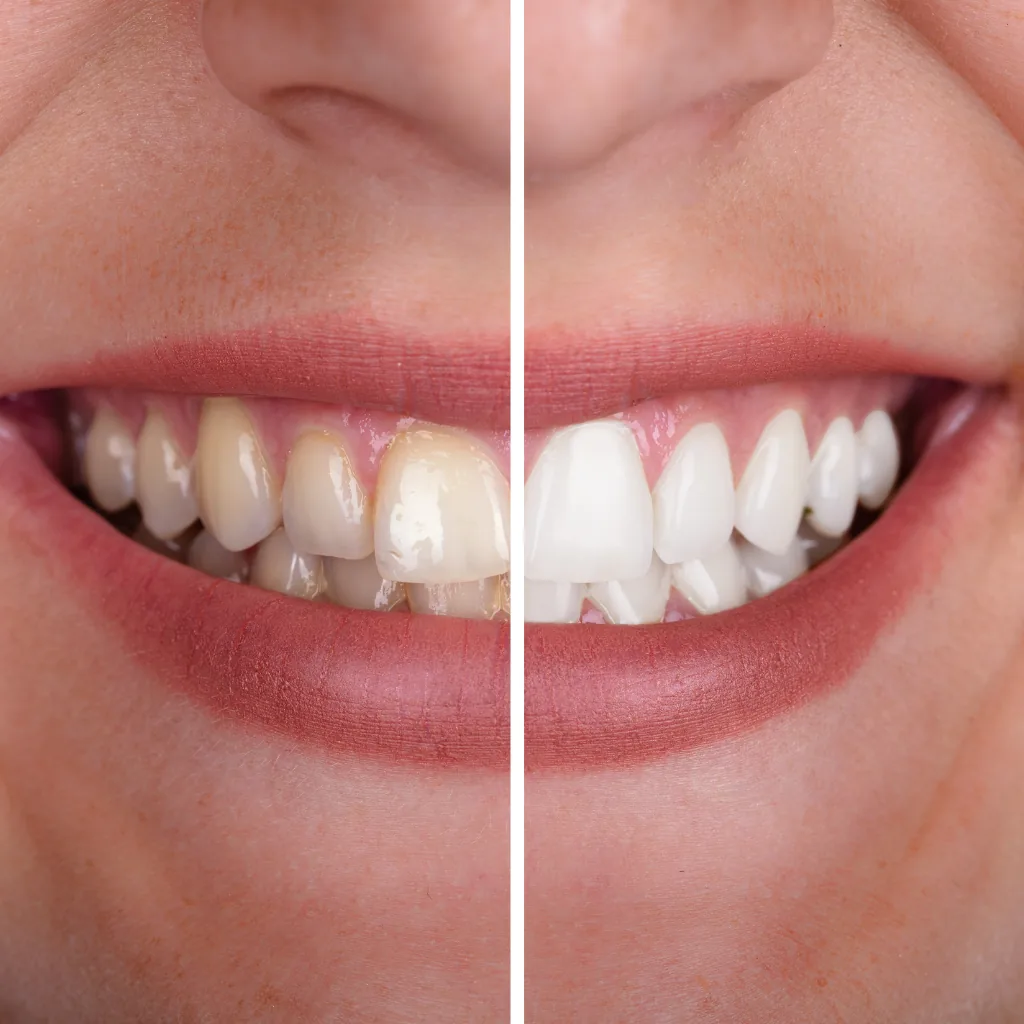 Zâmbet strălucitor obținut prin albire dentară profesională la Smile Design București