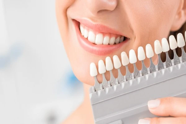 Alegerea nuanței dinților cu cheia de culori — consultație de albire la Smile Design București