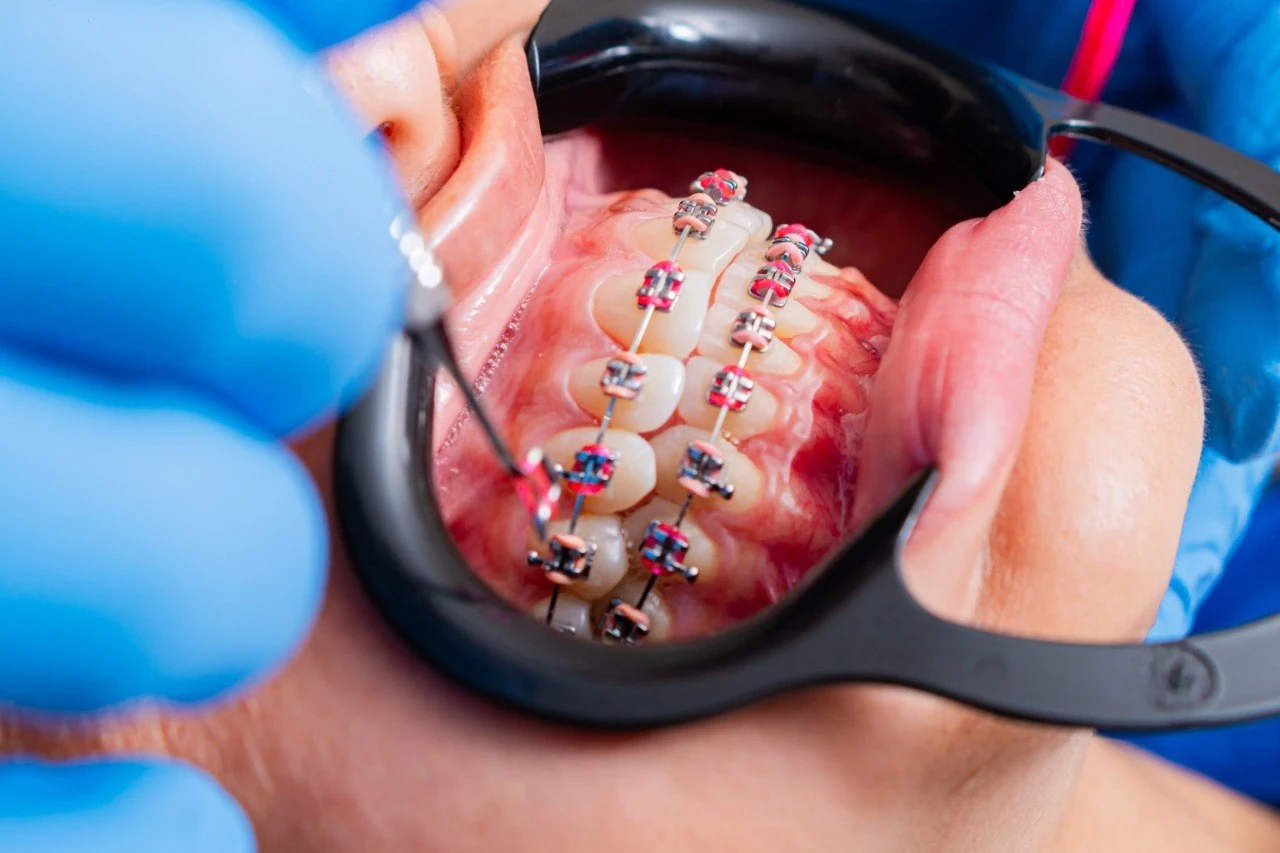 Zâmbet drept și aliniat obținut cu aparat dentar la Smile Design București