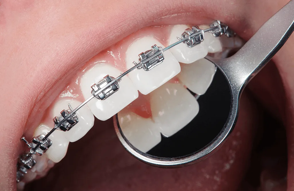 Bracketuri și arc metalic ale unui aparat dentar fix, examinate cu oglinda stomatologică — Smile Design București