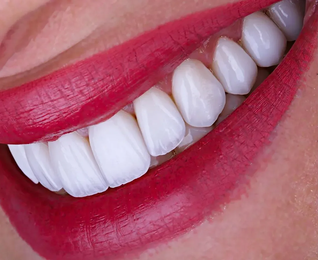 Fațete dentare premium, complet personalizate, la Smile Design București