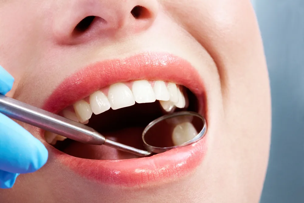 Igienizare dentară profesională la Smile Design București