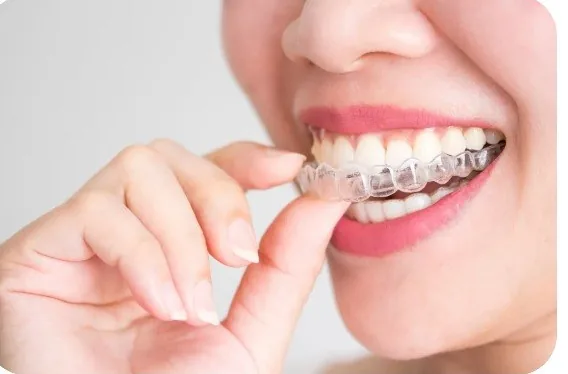 Gutieră transparentă Spark aplicată — tratament ortodontic discret la Smile Design București