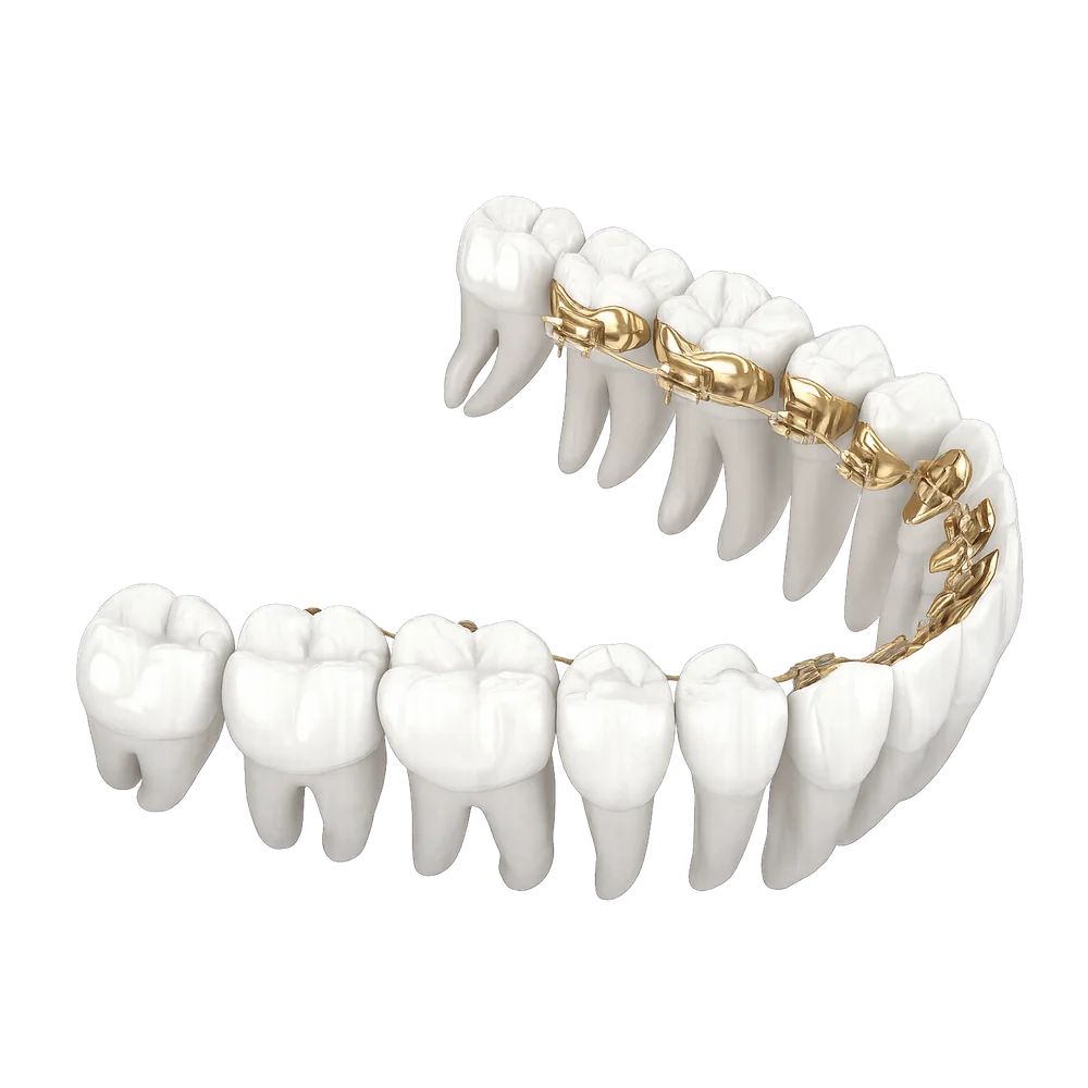 Aparat dentar lingual Incognito montat pe partea interioară a dinților — Smile Design București