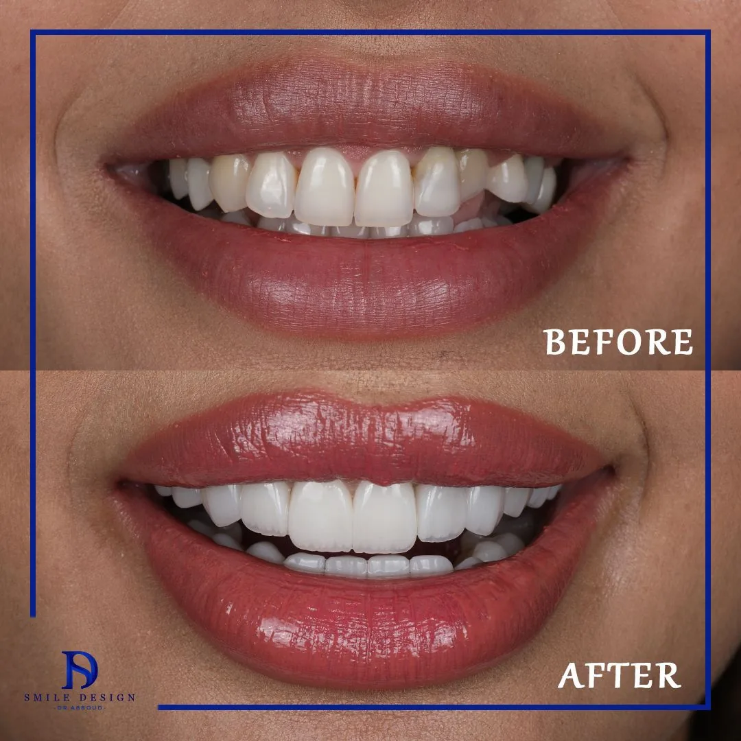 Zâmbet transformat cu fațete dentare Emax — rezultat înainte și după, la Smile Design București