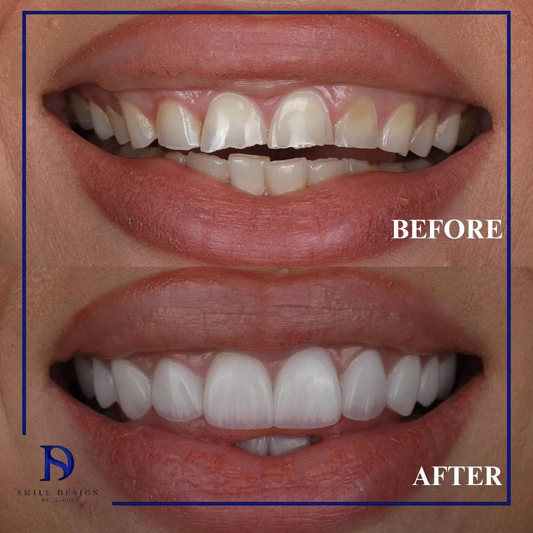Rezultat înainte și după — Smile Design București