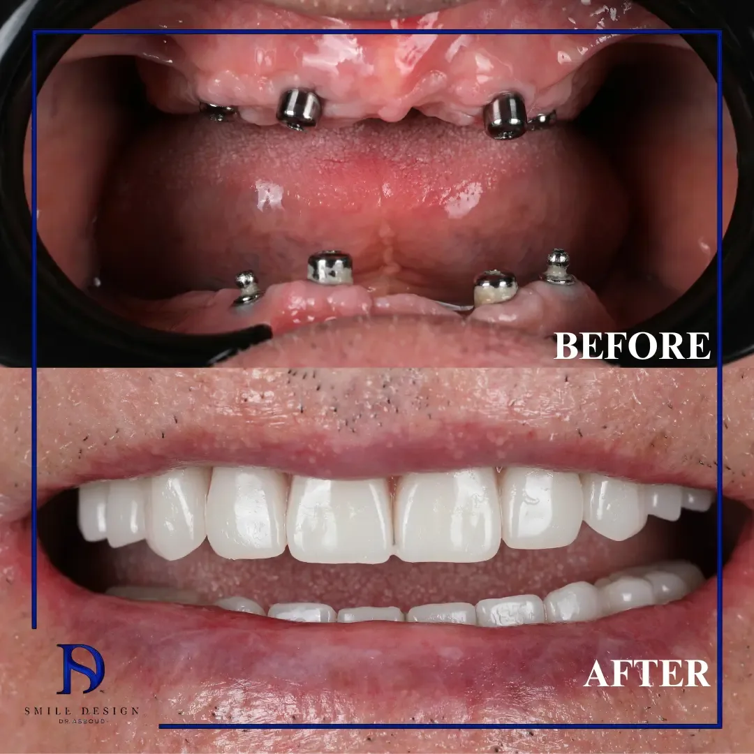 Rezultat înainte și după — Smile Design București