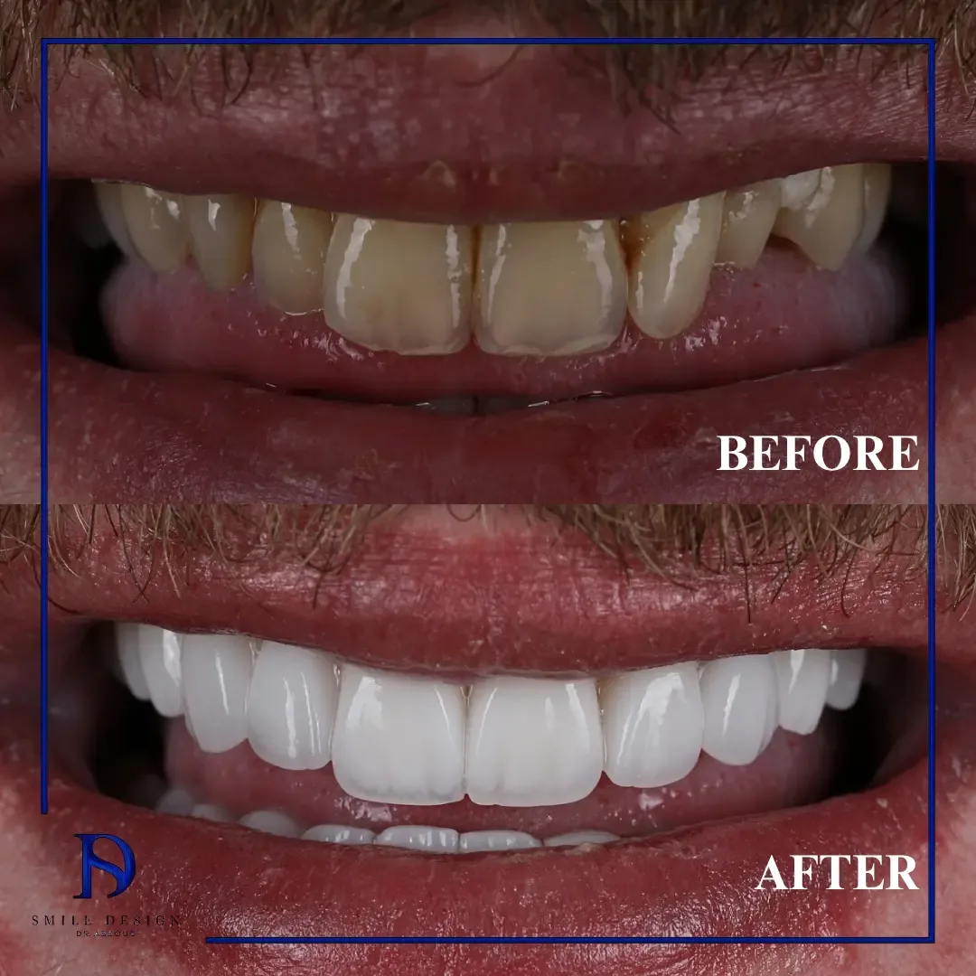 Rezultat înainte și după — Smile Design București