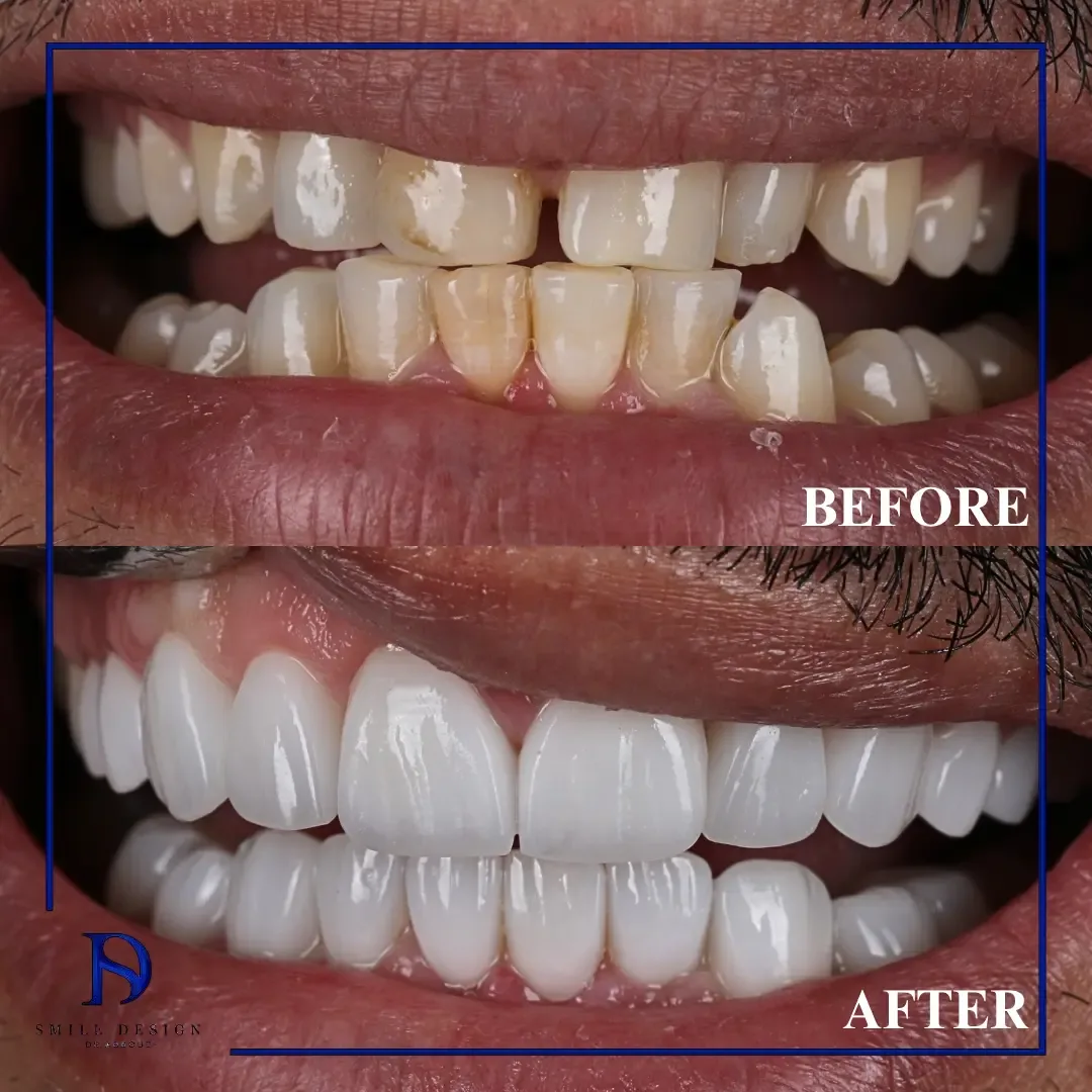 Rezultat înainte și după — Smile Design București