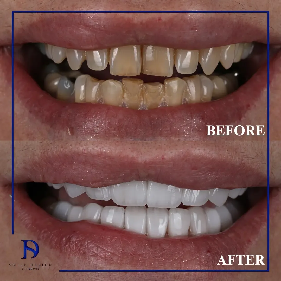 Rezultat înainte și după — Smile Design București