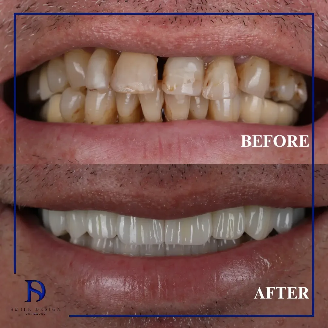 Rezultat înainte și după — Smile Design București