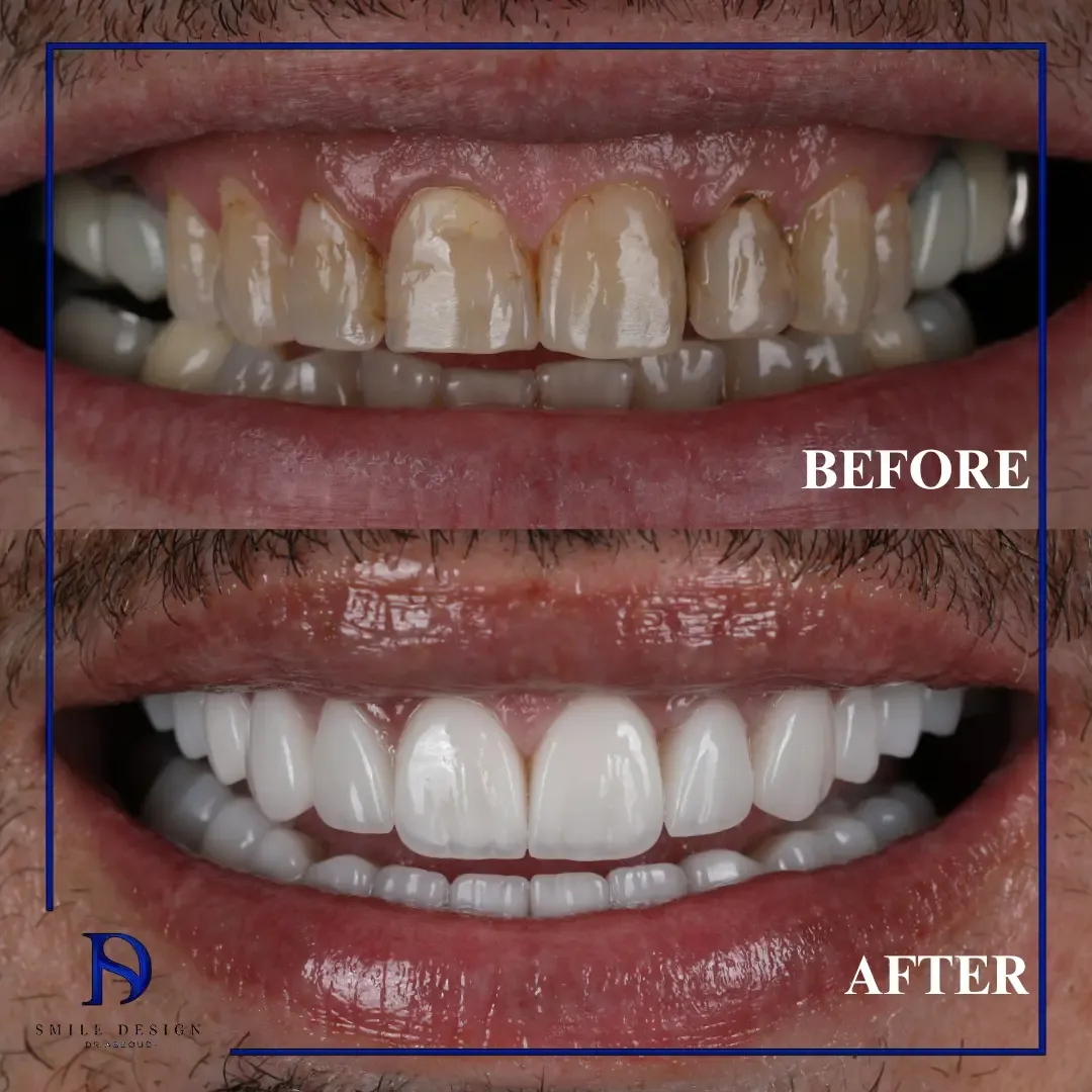 Rezultat înainte și după — Smile Design București