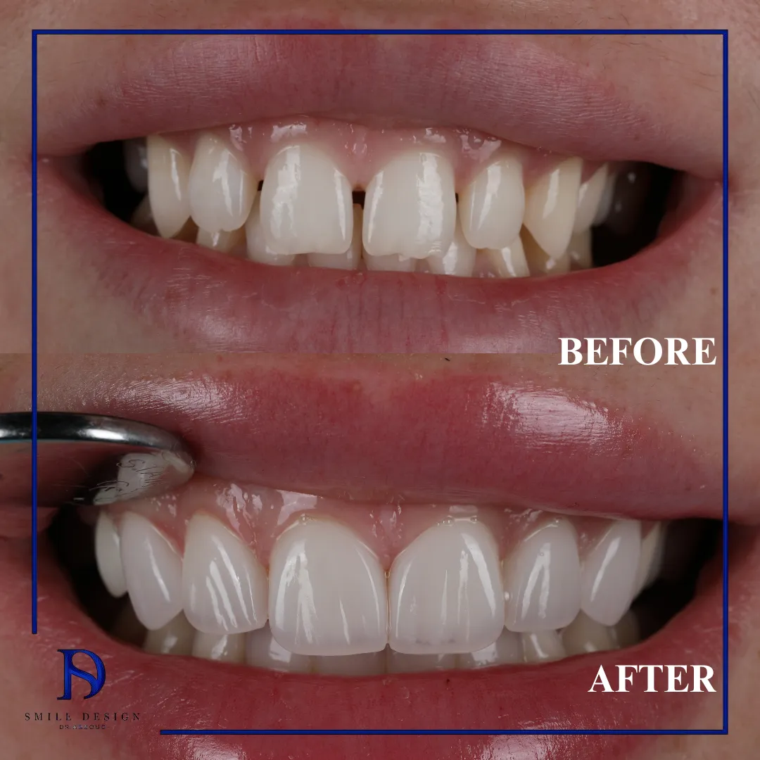 Transformare înainte și după realizată la Smile Design București — cazul 2