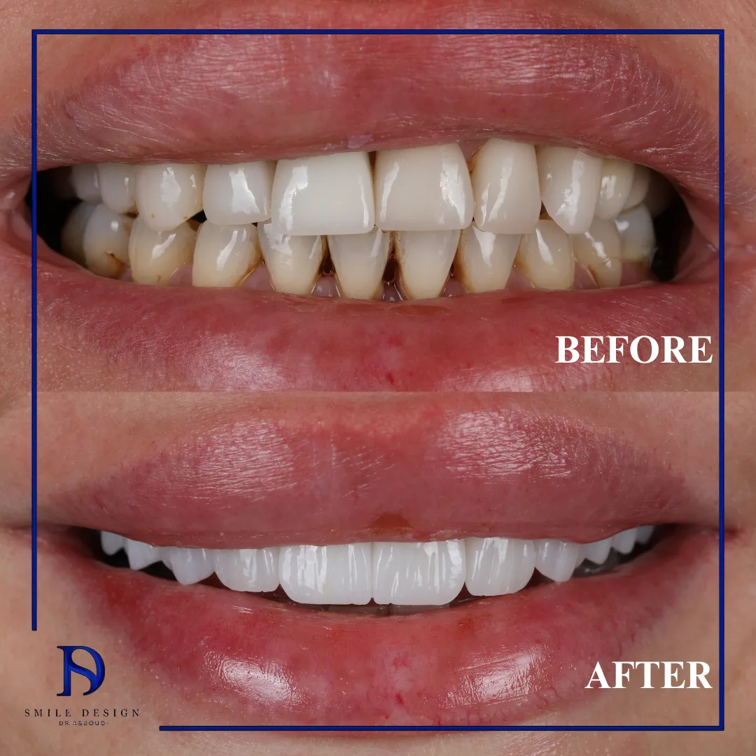 Transformare înainte și după realizată la Smile Design București — cazul 3