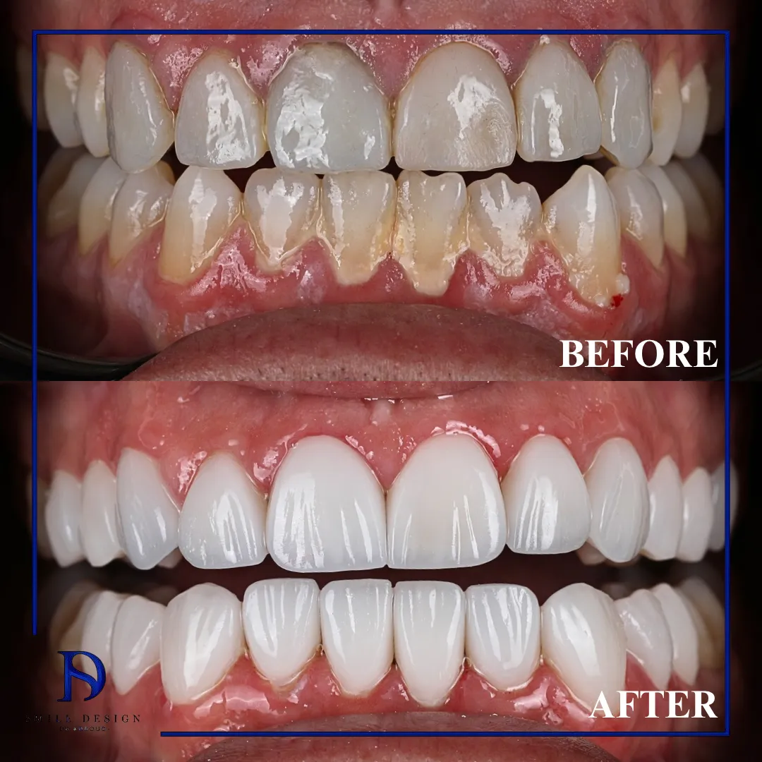 Transformare înainte și după realizată la Smile Design București — cazul 5