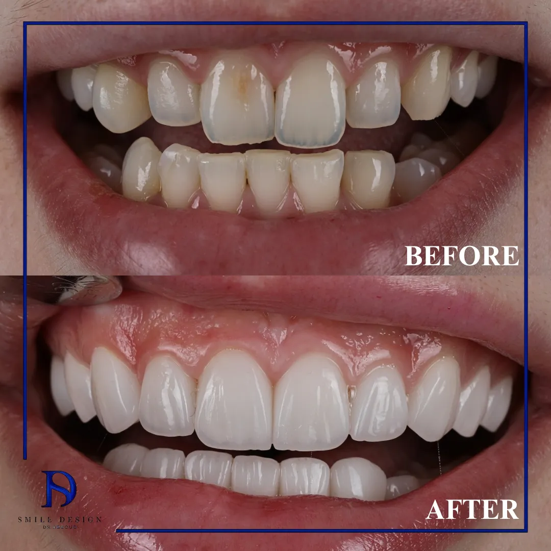 Transformare înainte și după realizată la Smile Design București — cazul 9