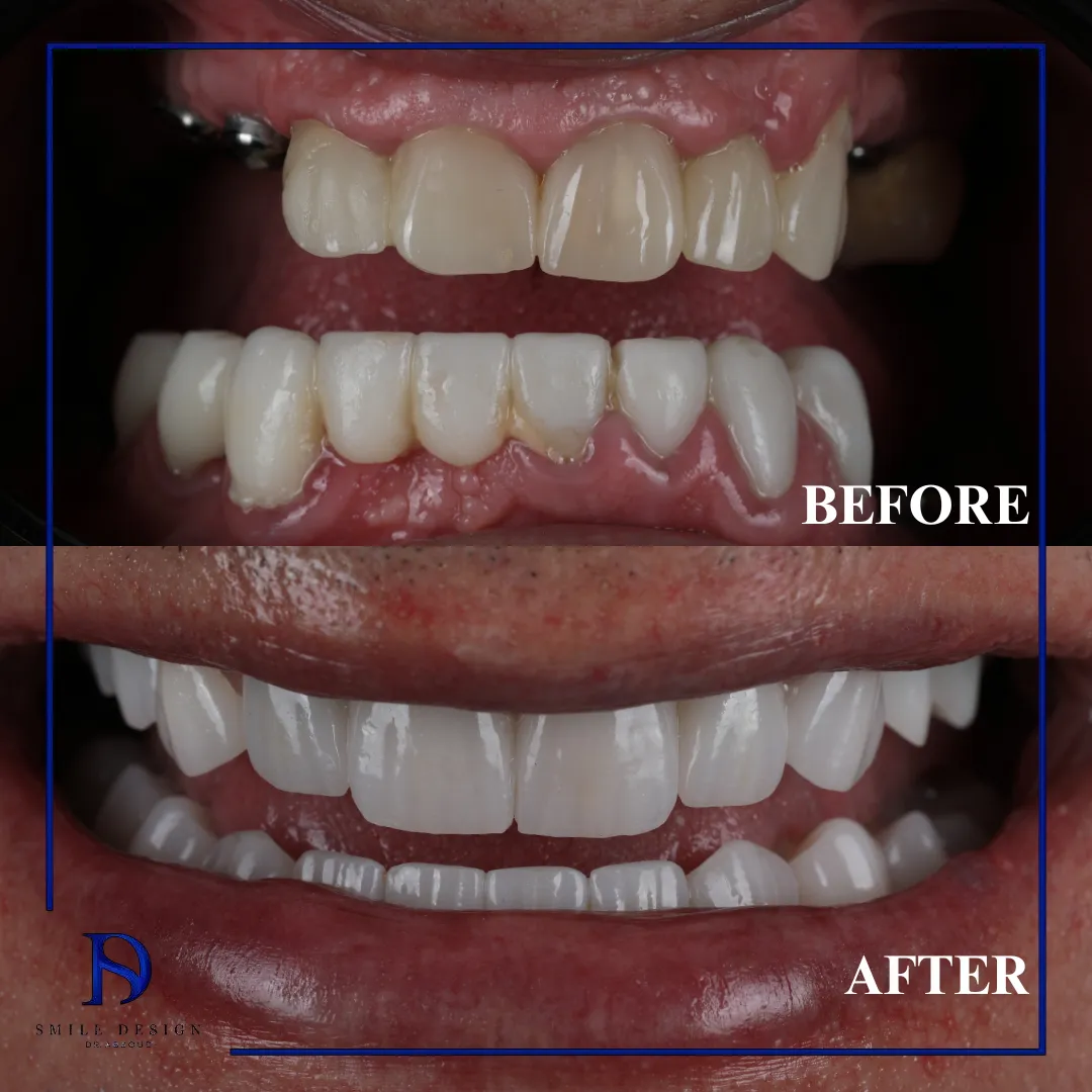 Transformare înainte și după realizată la Smile Design București — cazul 12
