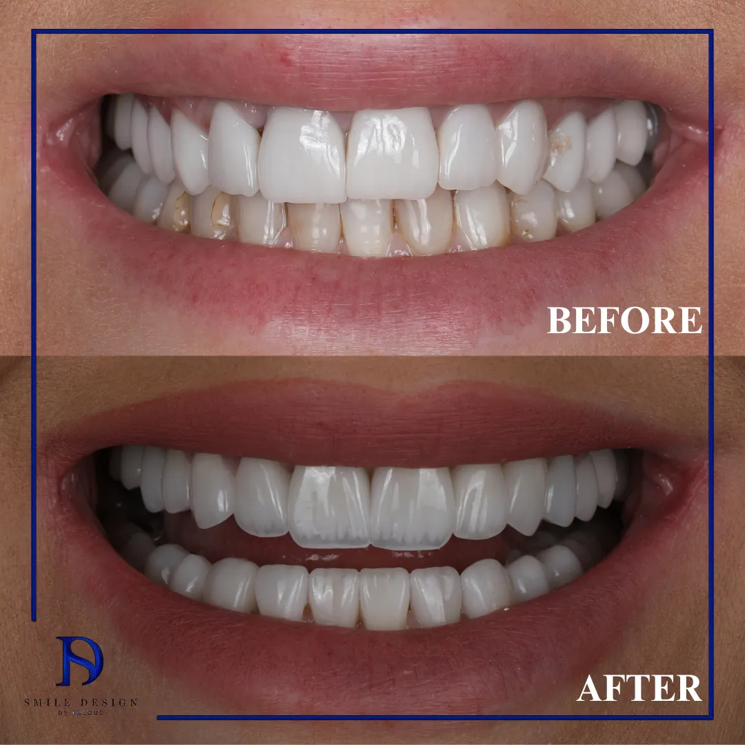 Transformare înainte și după realizată la Smile Design București — cazul 16