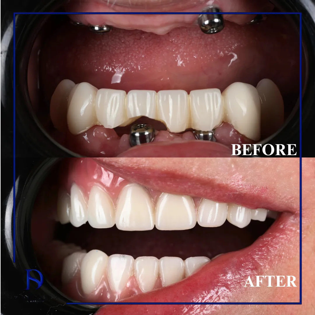 Transformare înainte și după realizată la Smile Design București — cazul 6