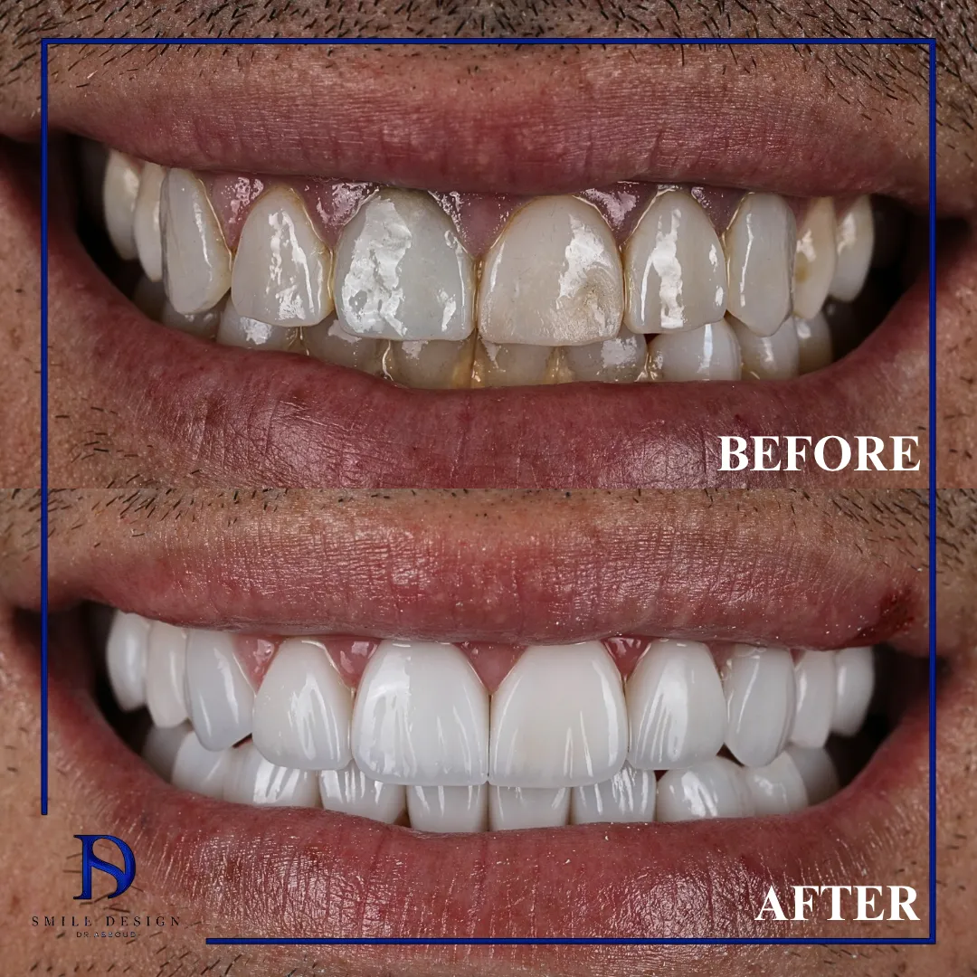 Transformare înainte și după realizată la Smile Design București — cazul 7