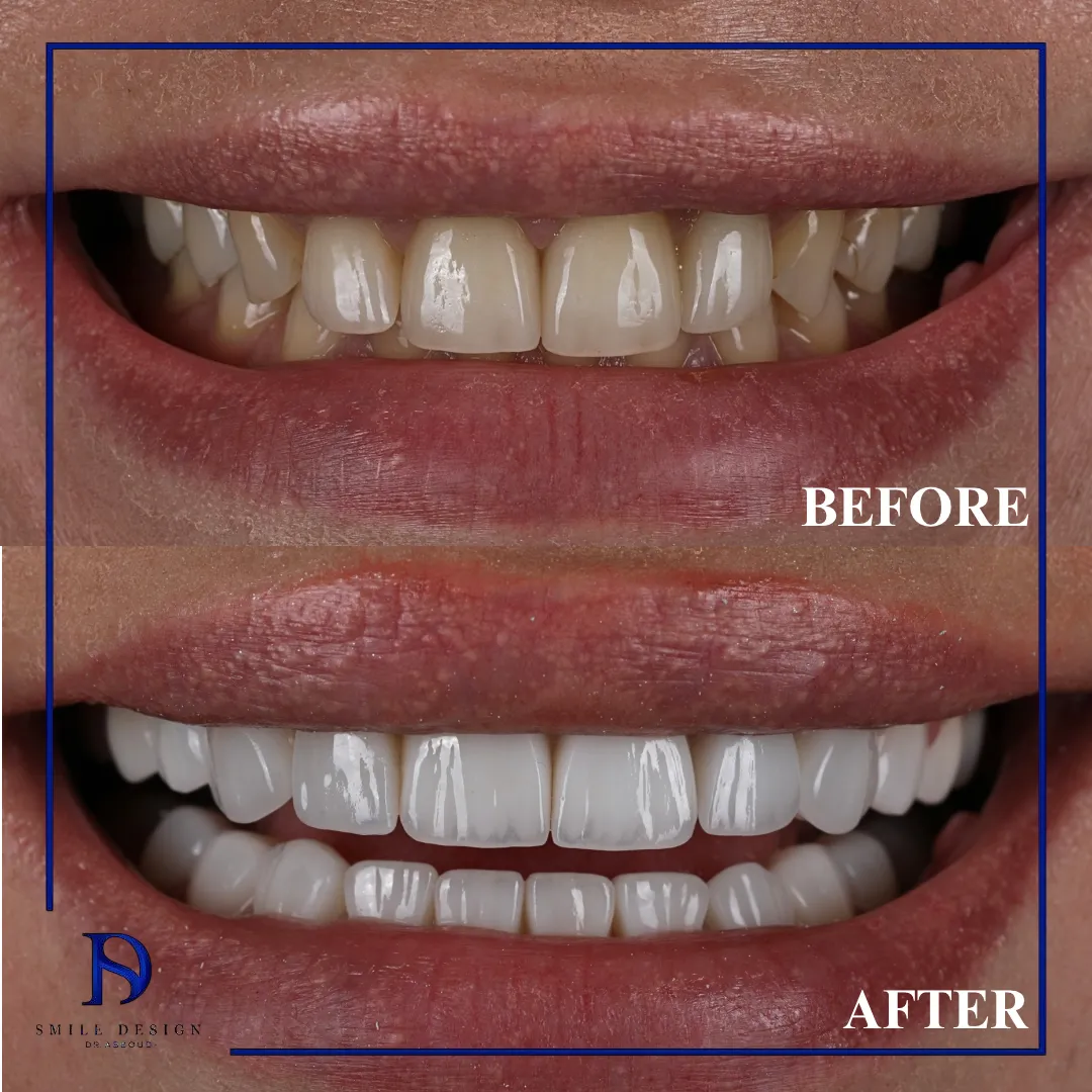 Transformare înainte și după realizată la Smile Design București — cazul 10