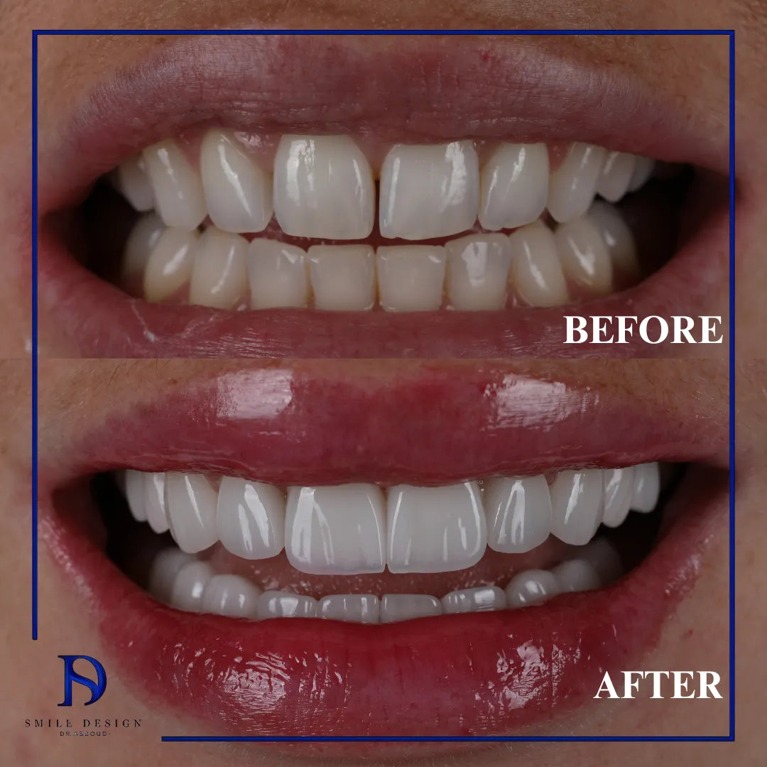 Transformare înainte și după realizată la Smile Design București — cazul 11