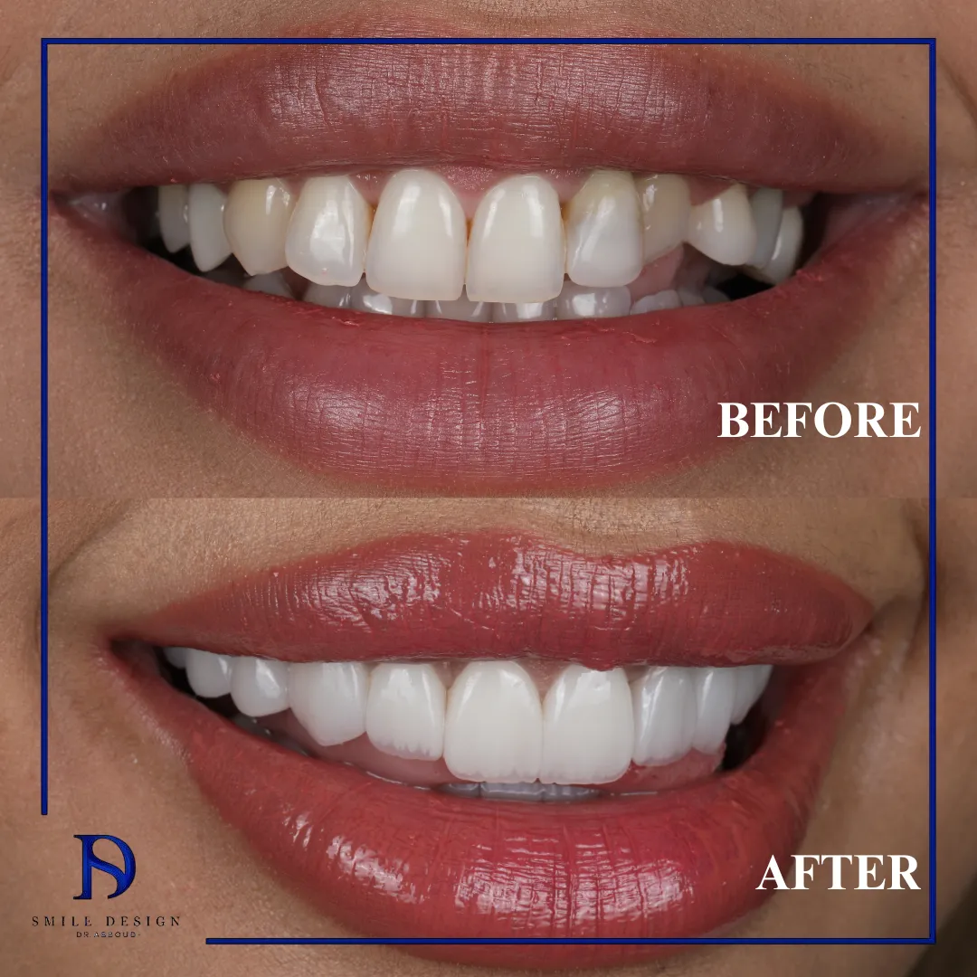 Transformare înainte și după realizată la Smile Design București — cazul 13