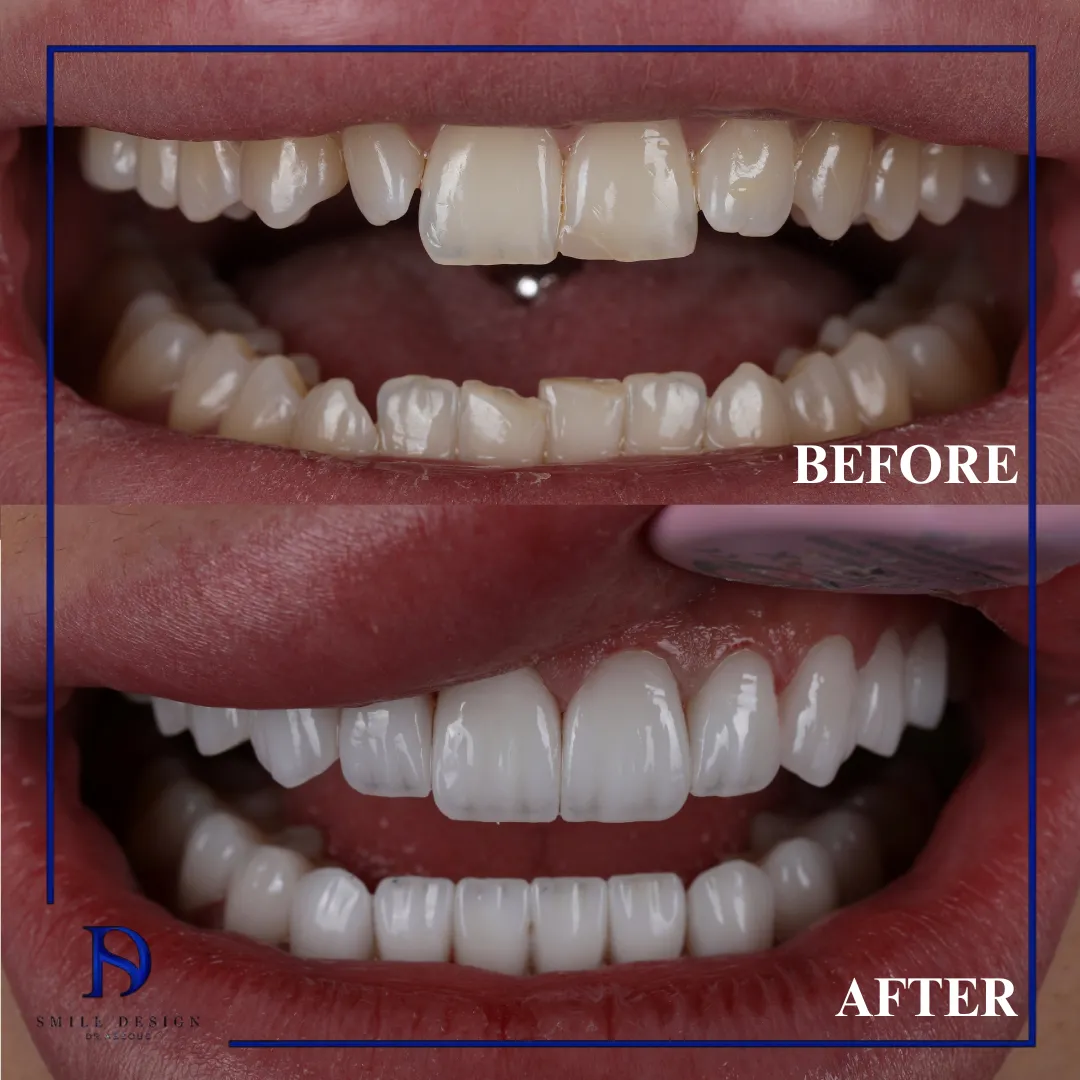 Transformare înainte și după realizată la Smile Design București — cazul 14