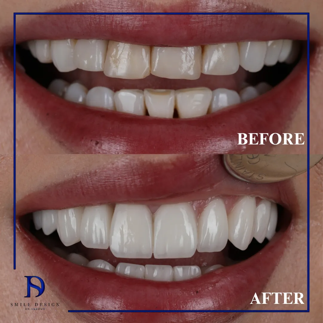 Transformare înainte și după realizată la Smile Design București — cazul 15