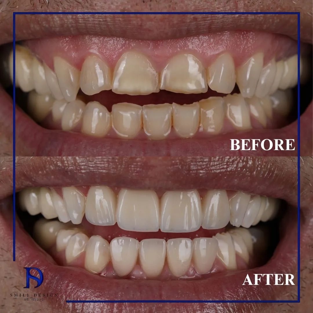 Transformare înainte și după realizată la Smile Design București — cazul 19