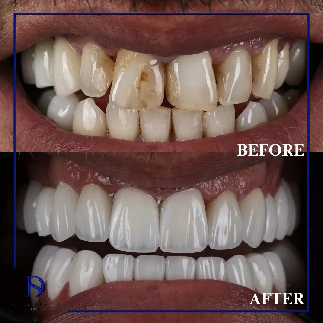 Transformare înainte și după realizată la Smile Design București — cazul 20