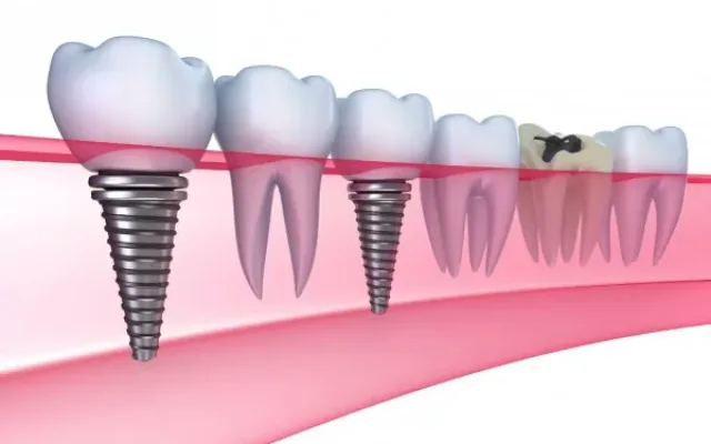 Implant dentar — tratament la clinica Smile Design București