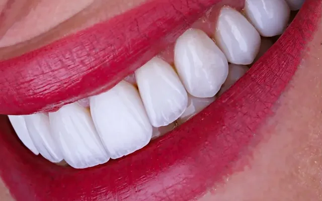 Fațete dentare — tratament la clinica Smile Design București