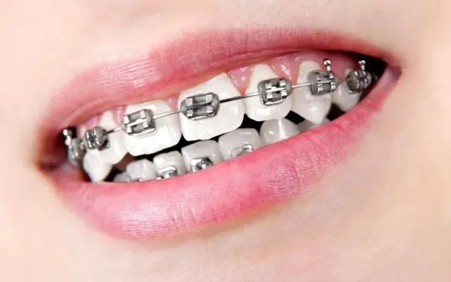 Ortodonție — tratament la clinica Smile Design București