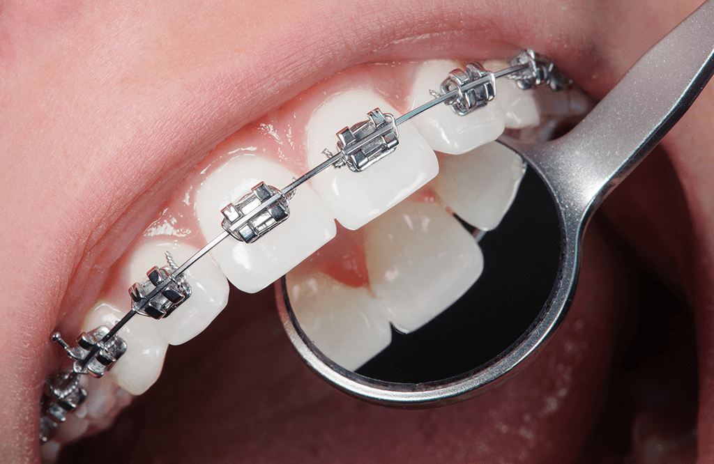 Blossom champion Moving Ortodontie aparat dentar Aparat Dentar - Smile Design Bucuresti